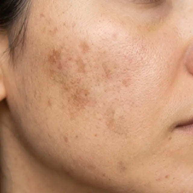 Melasma